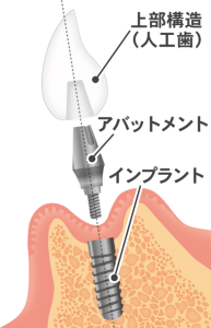 札幌市豊平区 たく歯科 インプラント治療とは？